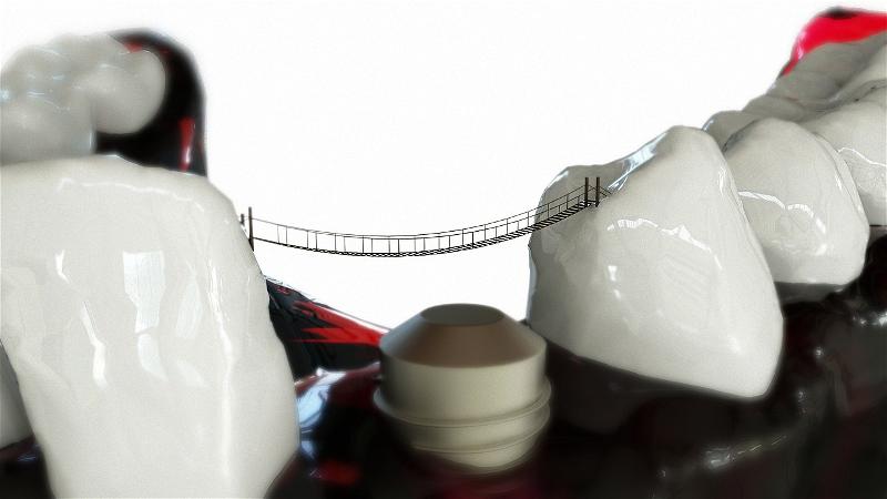 Răng Giả 3D Được Tích Hợp Sẵn Thuốc Giúp Chống Các Bệnh Về Răng Miệng